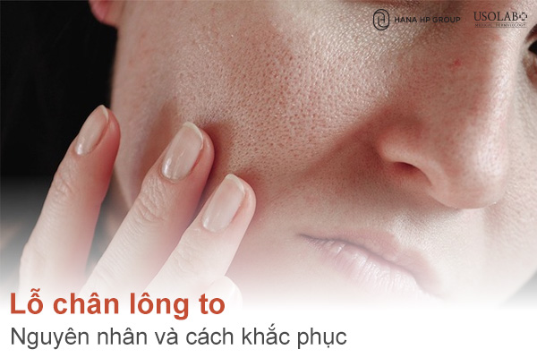 Nguyên nhân khiến lỗ chân lông to và cách khắc phục