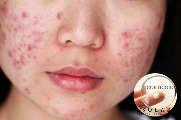 Corticoid từng được xem là “thần dược” trong điều trị da liễu