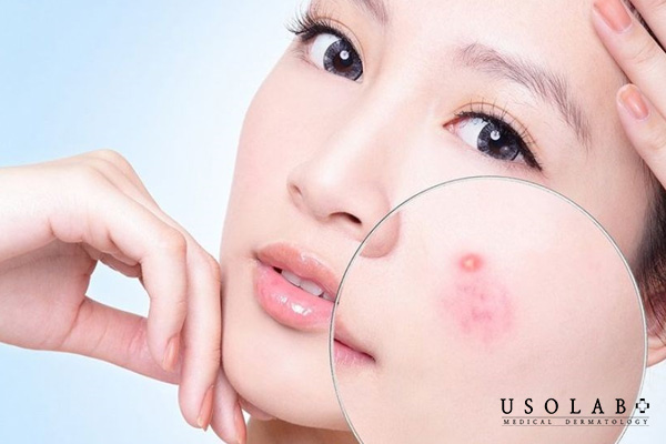 Dù đang gặp vấn đề mụn vẫn rất cần được bảo vệ bằng kem chống nắng 