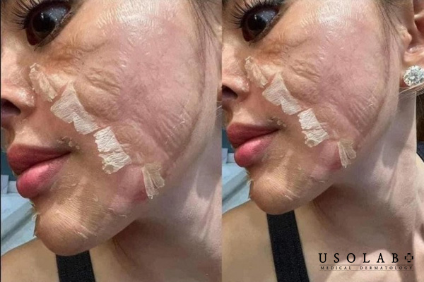 Những dấu hiệu “bất thường” sau khi peel da