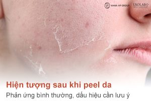 Hiện tượng sau khi peel da: Phản ứng bình thường, dấu hiệu cần lưu ý