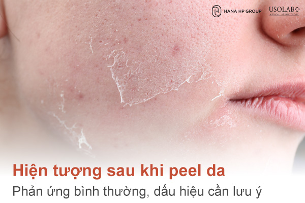 Hiện tượng sau khi peel da: Phản ứng bình thường, dấu hiệu cần lưu ý