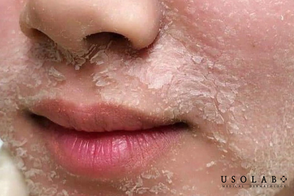Hiện tượng thường gặp sau khi peel da
