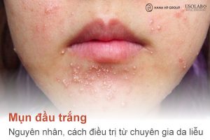 Mụn đầu trắng: Nguyên nhân, cách điều trị và lời khuyên từ chuyên gia da liễu