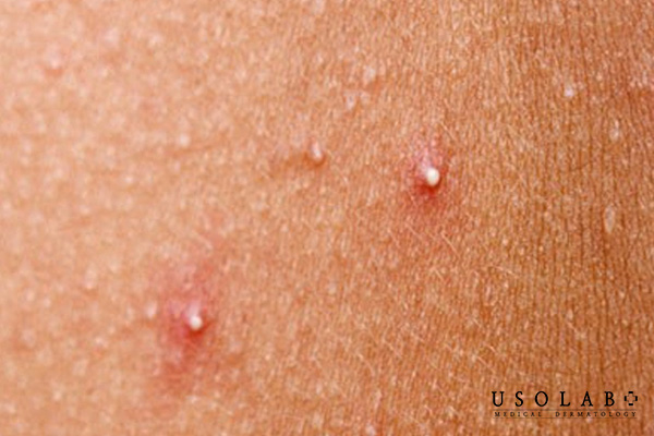 Là một dạng phổ biến của mụn trứng cá, thuộc nhóm mụn không viêm, không gây đau