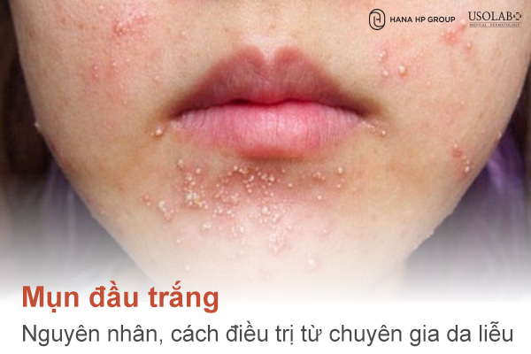 Mụn đầu trắng: Nguyên nhân, cách điều trị và lời khuyên từ chuyên gia da liễu