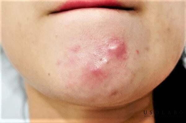 mụn dưới cằm