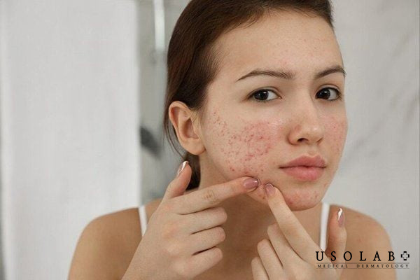 Những sai lầm nghiêm trọng trong điều trị mụn kích ứng