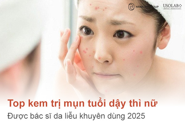 Top kem trị mụn tuổi dậy thì nữ được bác sĩ da liễu khuyên dùng 2025