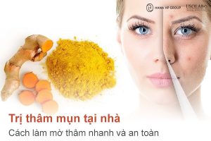 Trị thâm mụn tại nhà - Cách làm mờ thâm nhanh và an toàn