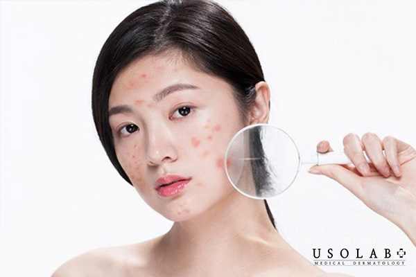 Do hormone Androgen tăng cao và sự phát triển của vi khuẩn P. acnes