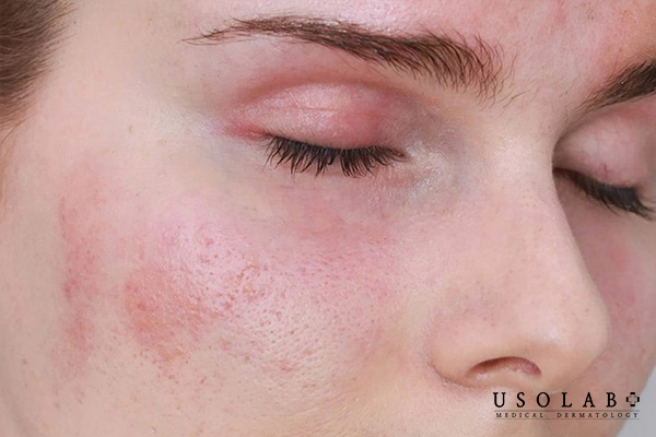 Bao lâu thì hết thâm sau khi bắn laser