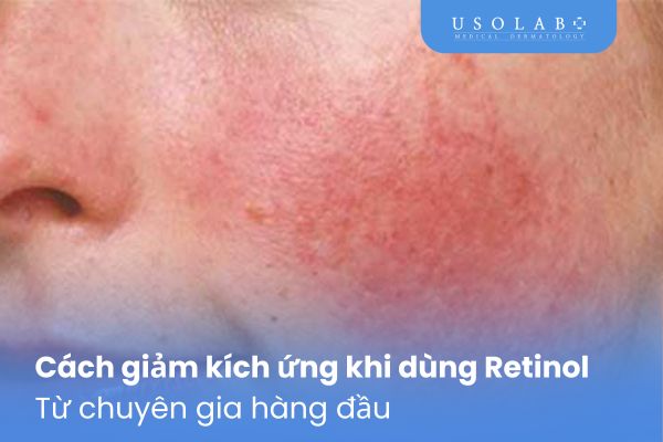 Cách giảm kích ứng khi dùng Retinol