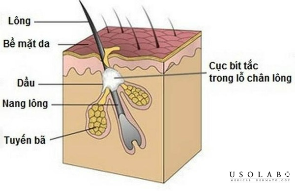 cách trị mụn không nhân