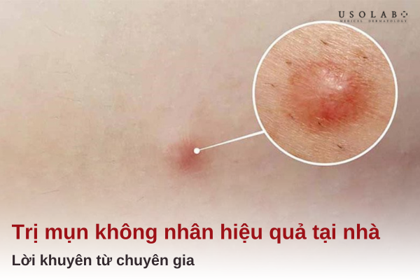 cách trị mụn không nhân