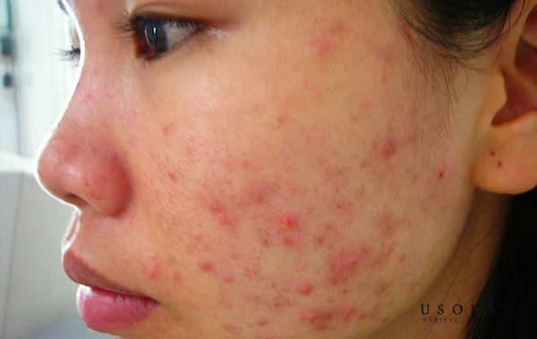mới nặn mụn xong nên làm gì