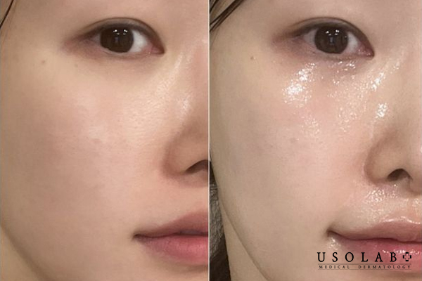 Dưỡng ẩm trước hoặc sau