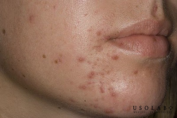 Thâm mụn không chỉ đơn thuần là “vết sẹo” sau mụn