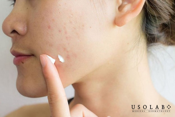 Lưu ý khi bôi thuốc sau khi nặn mụn để tránh nhiễm trùng và sẹo thâm