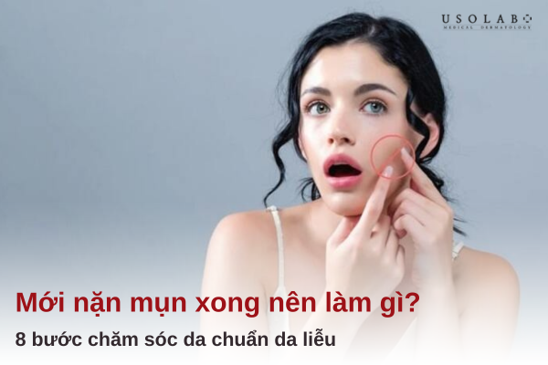 mới nặn mụn xong nên làm gì