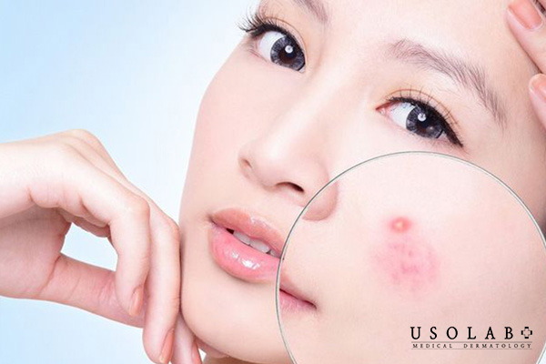 Câu hỏi thường gặp khi lên mụn ở má phải