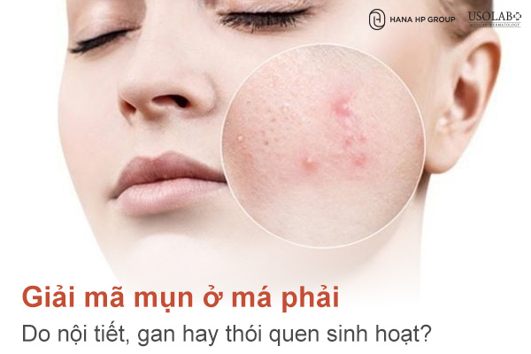 Mụn ở má phải