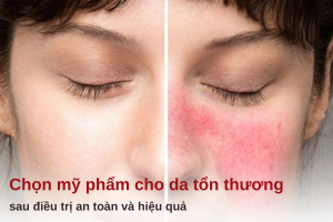 mỹ phẩm cho da tổn thương sau điều trị
