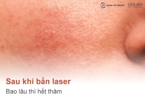 Sau khi bắn laser bao lâu thì hết thâm? Giải đáp từ chuyên gia da liễu