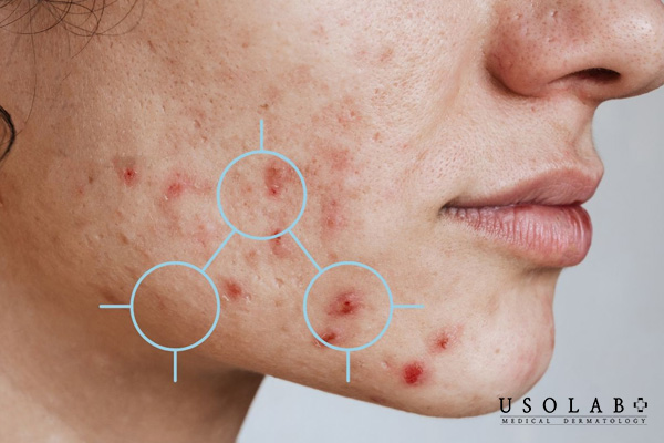 Sau khi nặn mụn da sưng đỏ