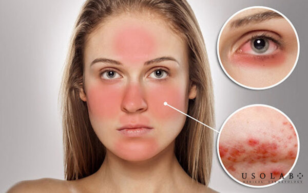 serum phục hồi cho da nhạy cảm