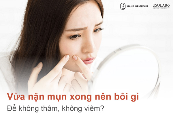 vừa nặn mụn xong nên bôi gì