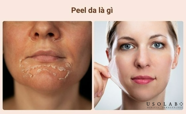 Bao lâu thì peel da 1 lần
