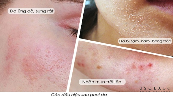 Bao lâu thì peel da 1 lần