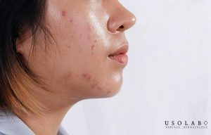 cách khắc phục da nhờn