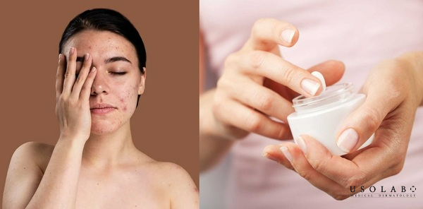 cách làm trắng da nhờn