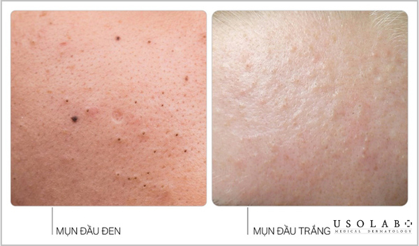 Cách lấy nhân mụn không cần nặn
