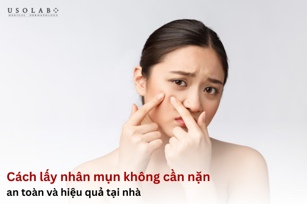 Cách lấy nhân mụn không cần nặn
