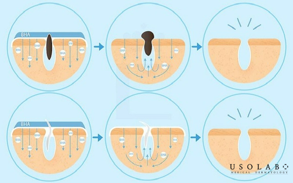 Cách lấy nhân mụn không cần nặn