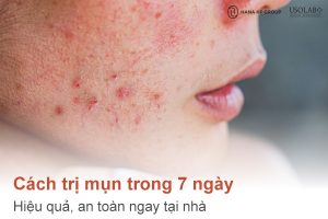 Cách trị mụn trong 7 ngày