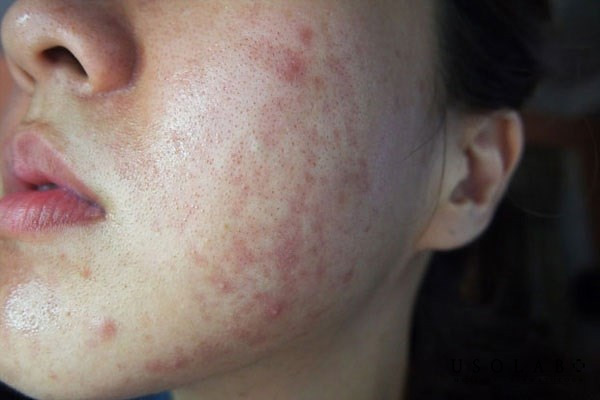 Câu hỏi thường gặp về dị ứng sữa rửa mặt
