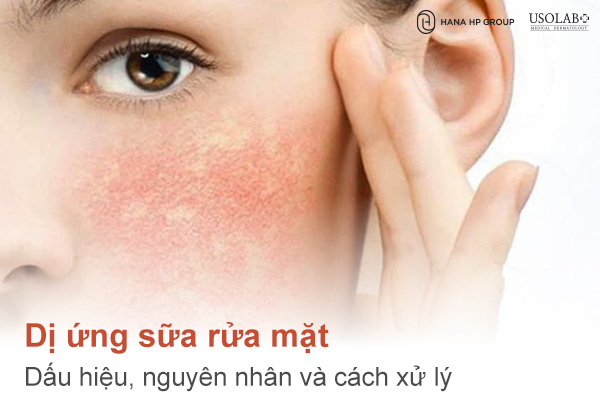 Dị ứng sữa rửa mặt