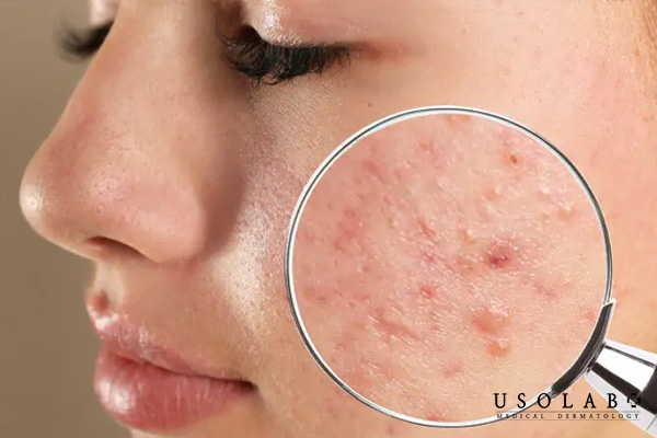 Hiểu về tình trạng mụn trước khi điều trị