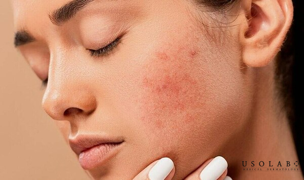 Kem chống nắng không gây kích ứng da