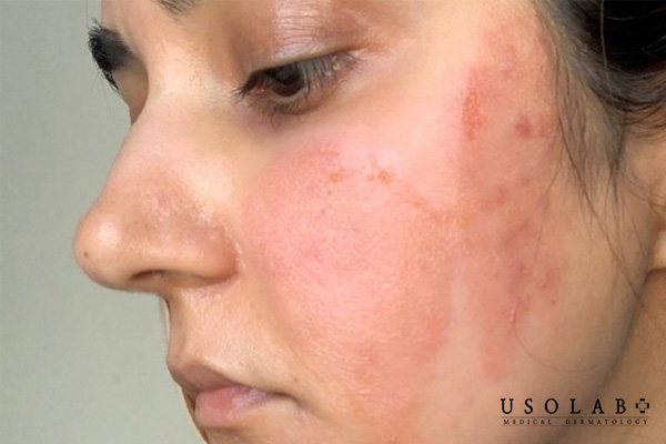 Nhận biết dấu hiệu peel da bị bỏng