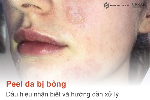 Peel da bị bỏng: Dấu hiệu nhận biết và hướng dẫn xử lý