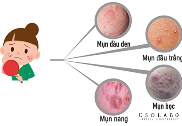 Sữa rửa mặt dành cho tuổi dậy thì