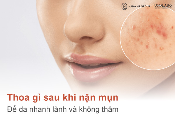 Thoa gì sau khi nặn mụn