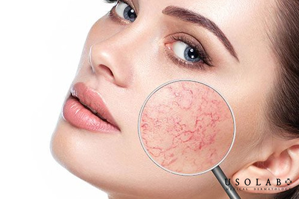 Thủ phạm khiến da mỏng và lộ mạch máu