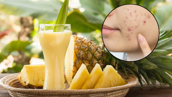 Dứa giúp giảm viêm, hỗ trợ trị mụn và tăng cường sản sinh collagen