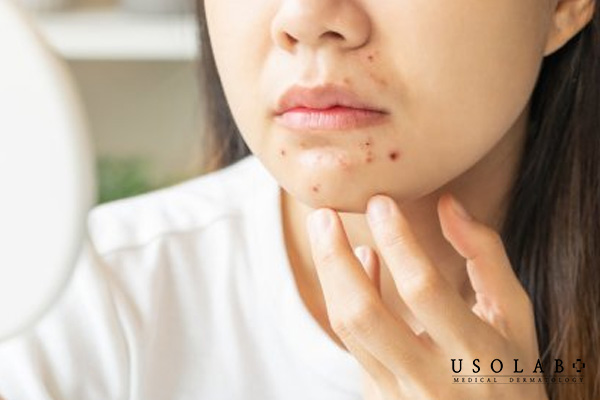Nguy cơ dị ứng và nổi mẩn và gây rối loạn chức năng gan thận